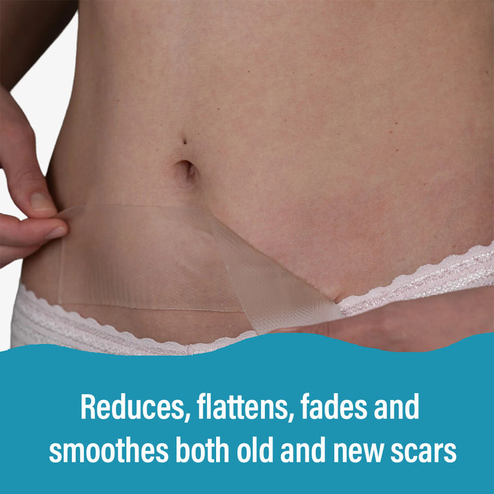 NewGel+ Advanced Medical-Grade 2" x 8" C-Section Strip For C-Section Scar Management, NG-360 Clear, Pack of 1's - Easy Pharmacy LLC