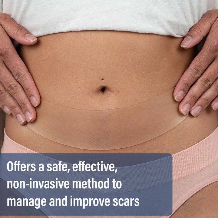 NewGel+ Advanced Medical-Grade 2" x 8" C-Section Strip For C-Section Scar Management, NG-360 Clear, Pack of 1's - Easy Pharmacy LLC