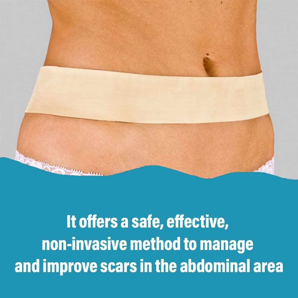 NewGel+ 24" x 2" Abdomen/Extremity Silicone Strip, Beige NG-164, Pack of 1's - Easy Pharmacy LLC