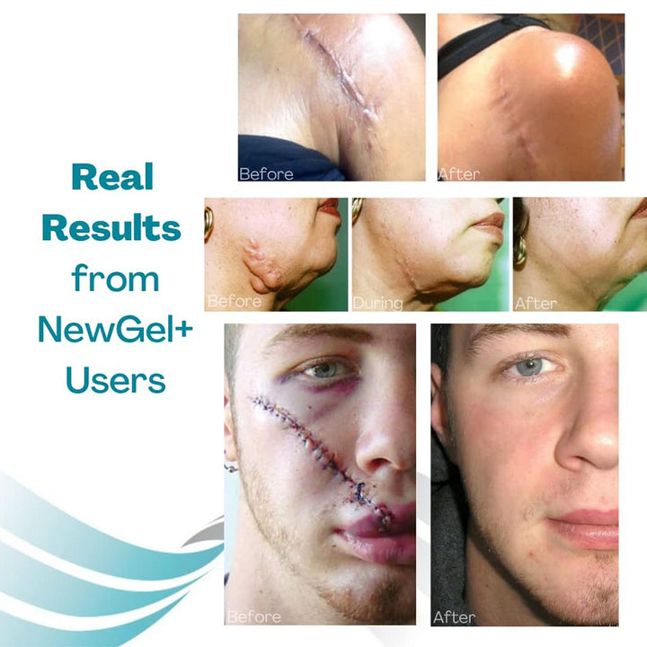 NewGel+ 24" x 2" Abdomen/Extremity Silicone Strip, Clear NG-364, Pack of 1's - Easy Pharmacy LLC