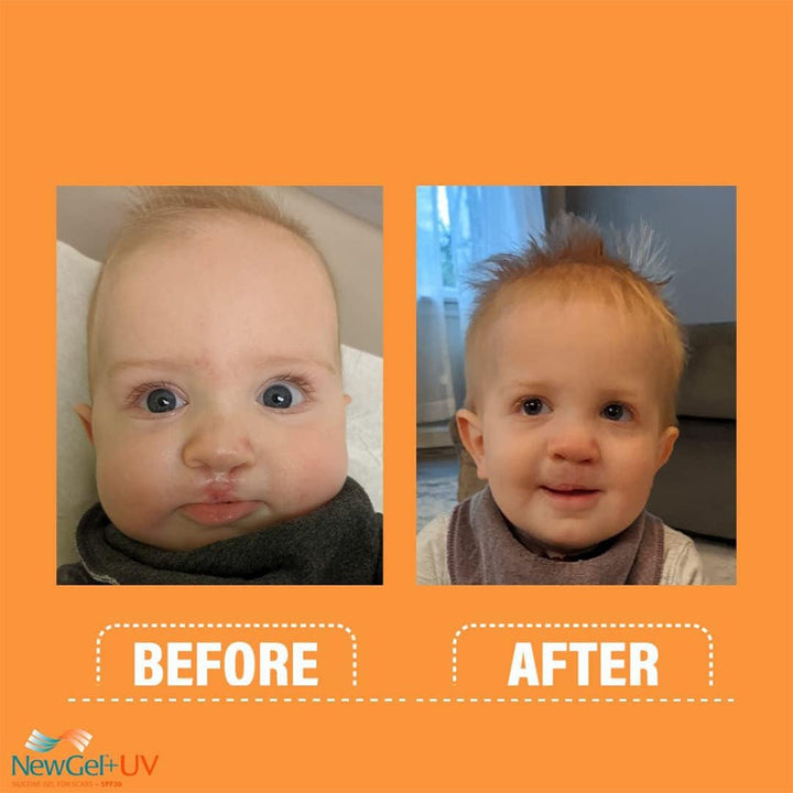 NewGel+UV Advanced Medical-Grade Silicone Scar Gel With SPF 30 15g - Easy Pharmacy LLC