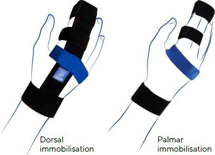 Thuasne Ligaflex Finger Wrist-Finger Support Brace S3 24320203 - Easy Pharmacy LLC