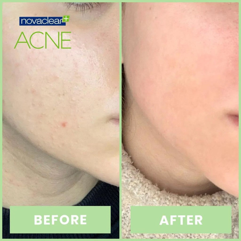 Novaclear Acne Cream With Salicylic Acid For Oily And Acne Prone Skin 40ml - Easy Pharmacy LLC