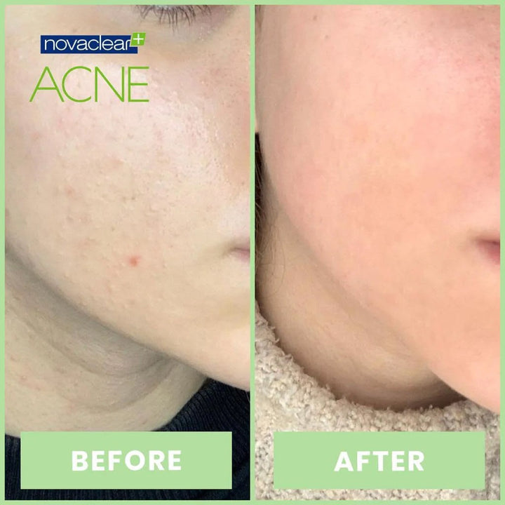 Novaclear Acne Cream With Salicylic Acid For Oily And Acne Prone Skin 40ml - Easy Pharmacy LLC