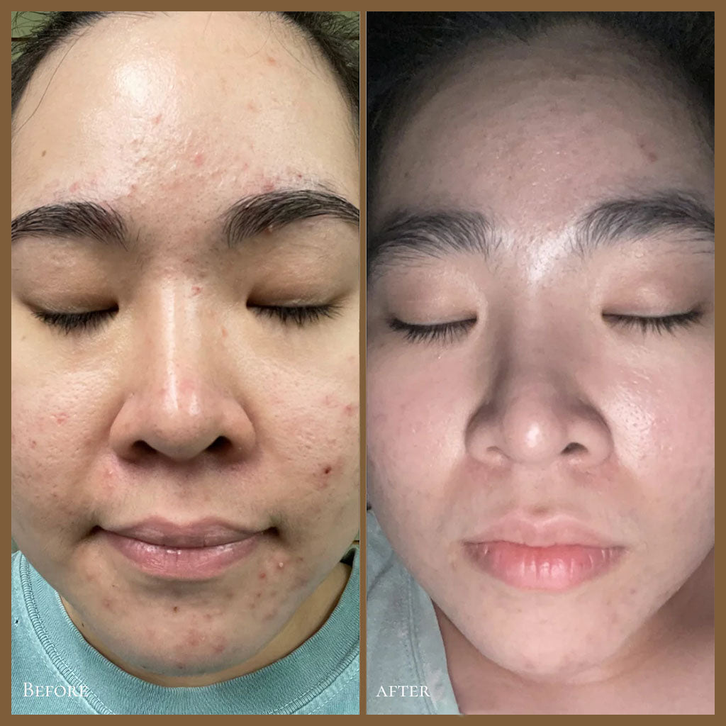GlowBiotics Probiotic Clarifying Home Peel For Acne With AHA and BHA 15ml - Easy Pharmacy LLC