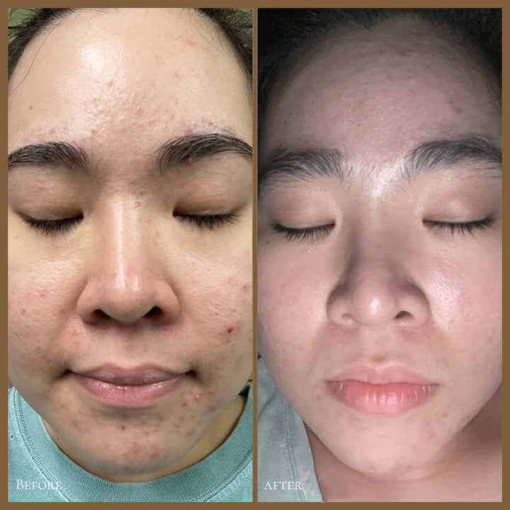 GlowBiotics Probiotic Clarifying Home Peel For Acne With AHA and BHA 15ml - Easy Pharmacy LLC