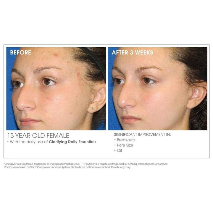 GlowBiotics Probiotic Acne Clarifying + Refining Treatment With AHA & BHA For Oily And Combination Skin 30ml - Easy Pharmacy LLC