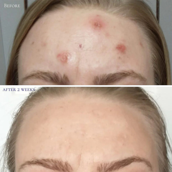 GlowBiotics Probiotic Clarifying Professional Peel For Acne With AHA & BHA 60ml - Easy Pharmacy LLC
