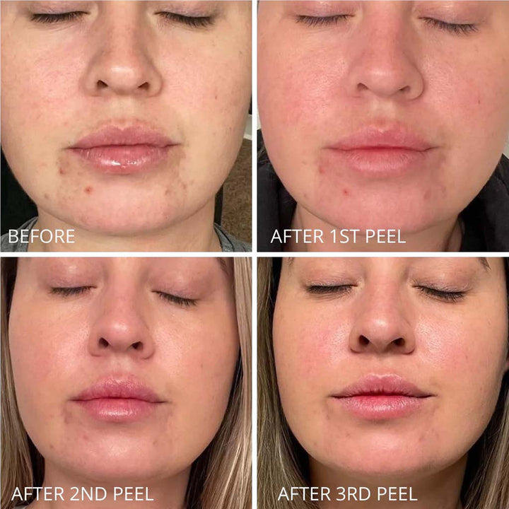 GlowBiotics Probiotic Clarifying Professional Peel For Acne With AHA & BHA 60ml - Easy Pharmacy LLC