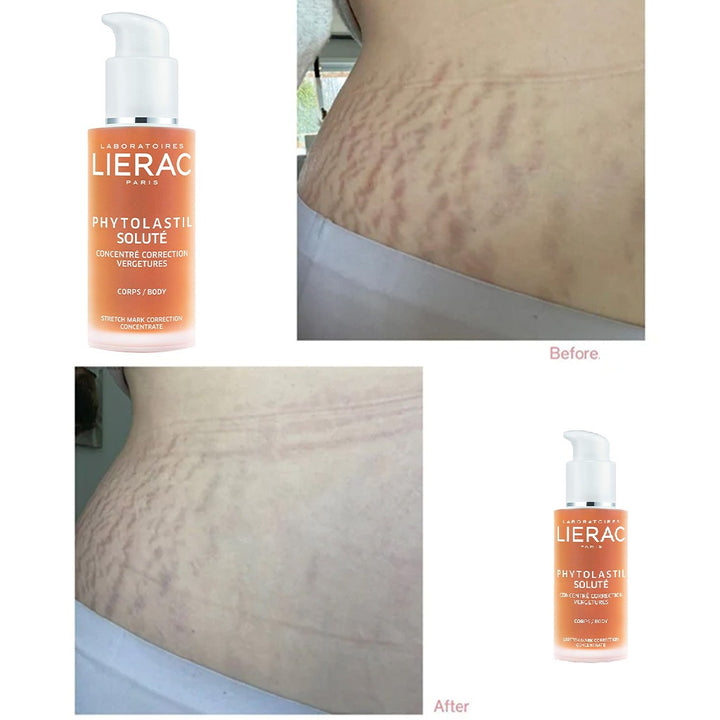 Lierac Phytolastil Solute Stretch Mark Correction Concentrate 75ml - Easy Pharmacy LLC