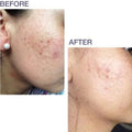 Biodermis Prosil SPF15 Silicone Scar Stick 4.25g Suitable For Scars